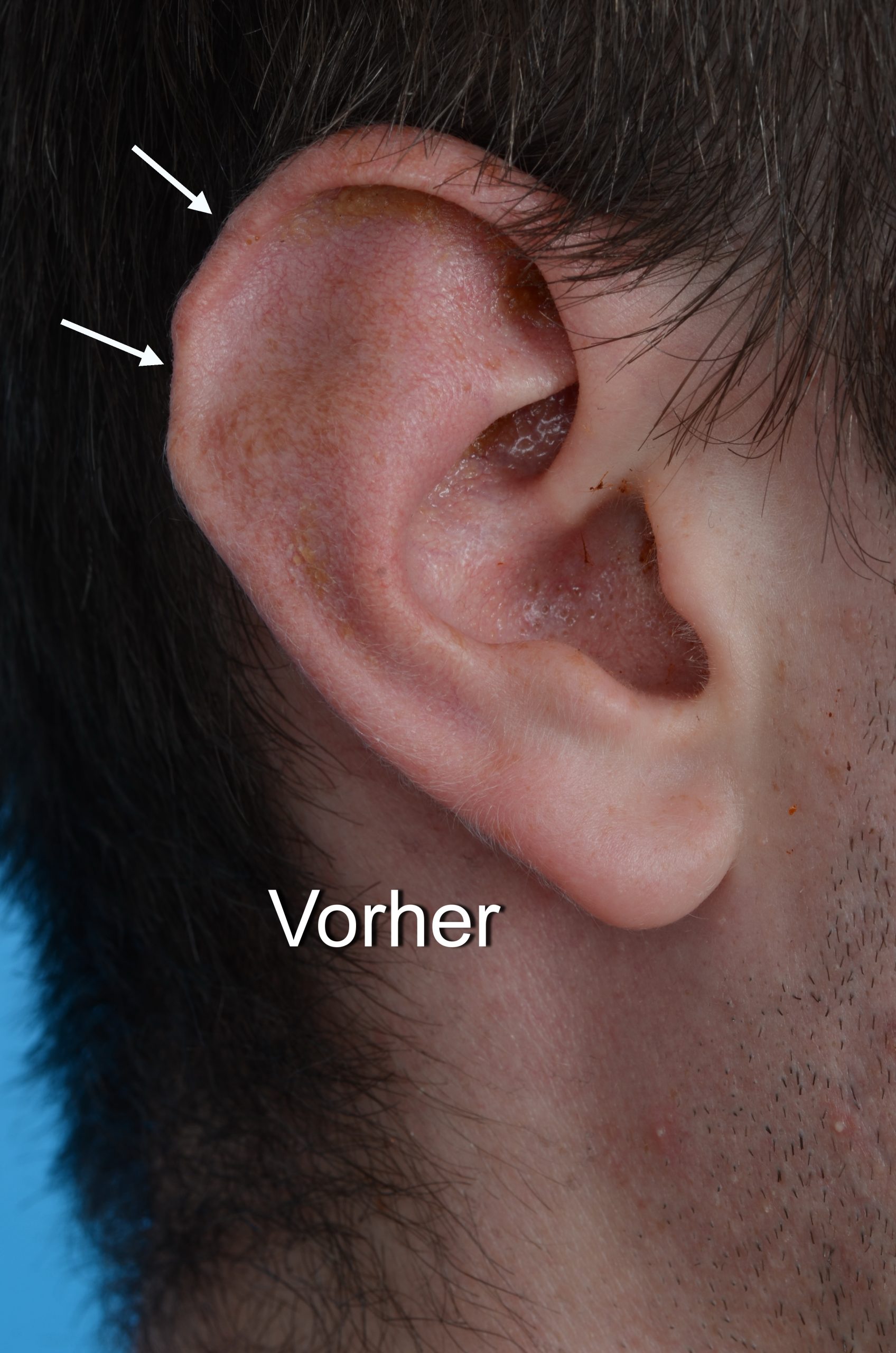 Reconstruction of the helical rim Dr. Gassner