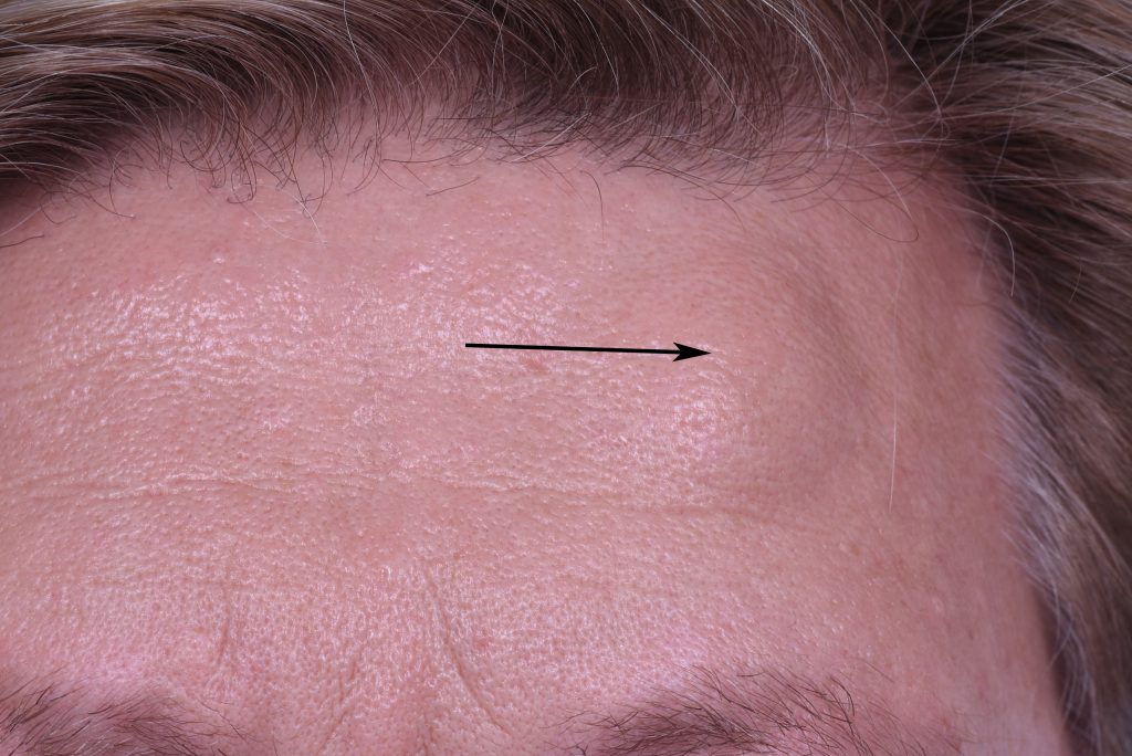 Forehead Osteoma Lipoma Dr Gassner